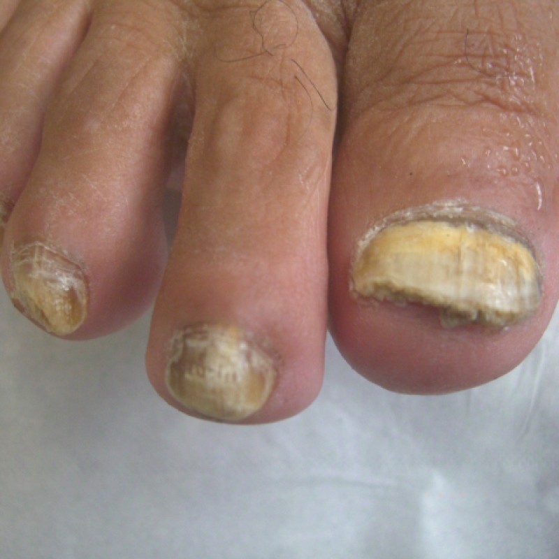 Fungal Nails