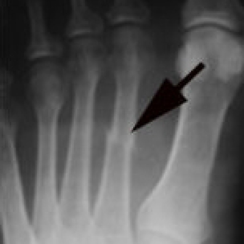 Fractures