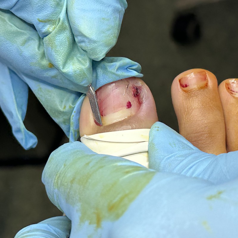 Ingrown Toenails
